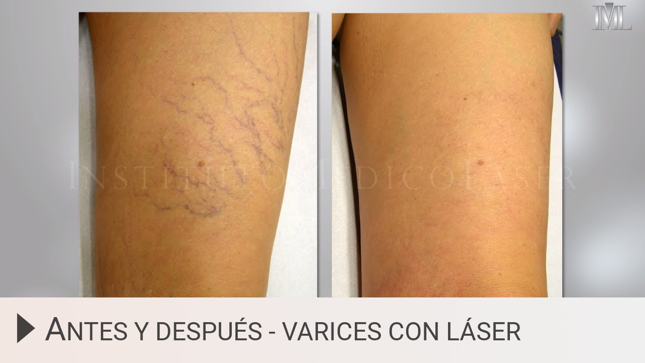tratamiento para varices